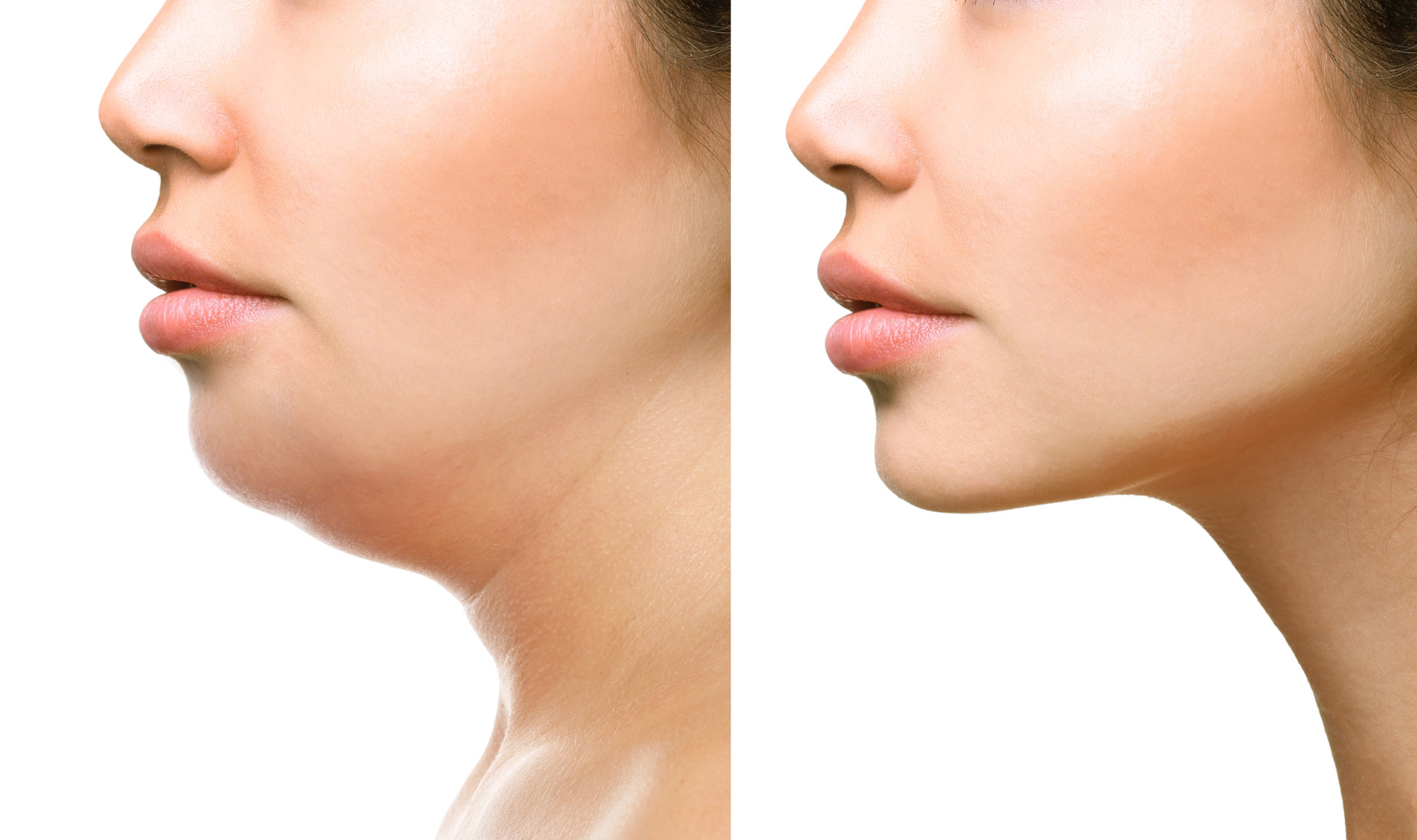 A Brief Guide to Kybella Injections | Blog | Miami Skin Dr.